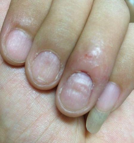 指甲凹凸不平 指甲根部肤色暗沉 发痒 严重的和指甲根部分离.