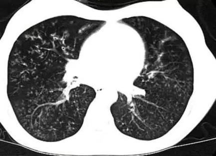 弥漫性泛细支气管炎的影像表现及鉴别诊断