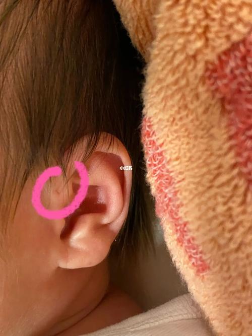 发现宝宝耳朵上有个小孔,长大了会闭合吗?