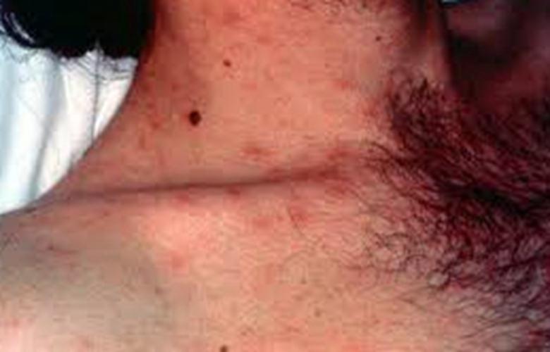 艾滋病初期指甲盖症状图片