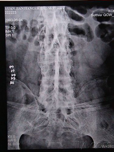典型强直性脊柱炎的片子