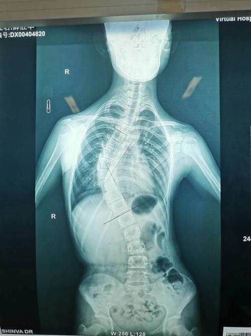 患者,女性,12岁8个月,发现脊柱弯曲4年,最近又加重趋势.