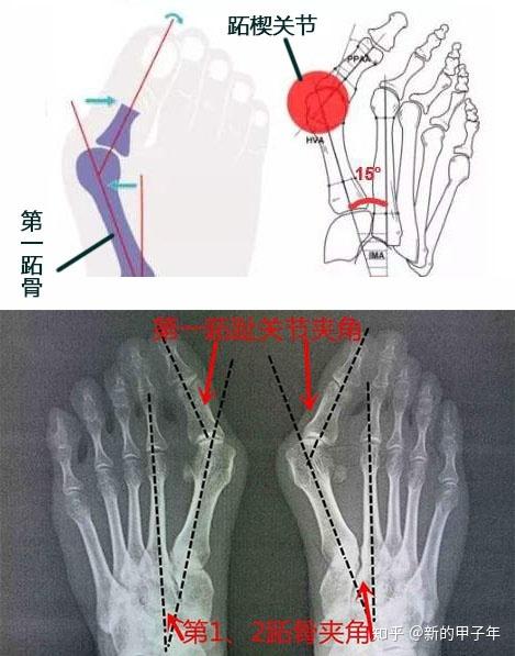 第一跖趾关节位置图片