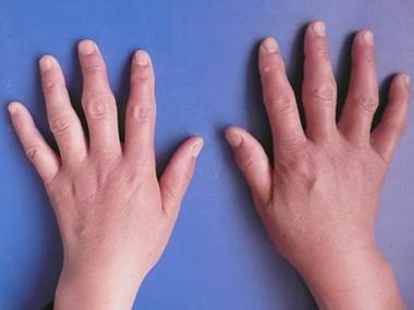 手指类风湿性关节炎手指肿胀图.jpg