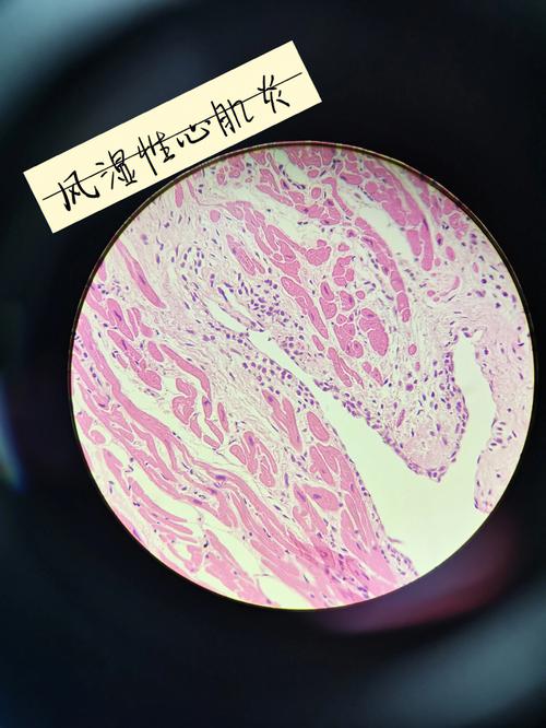 风湿肉芽肿的形成是由风湿细胞,风湿巨细胞,纤维素性坏死物,淋巴细胞