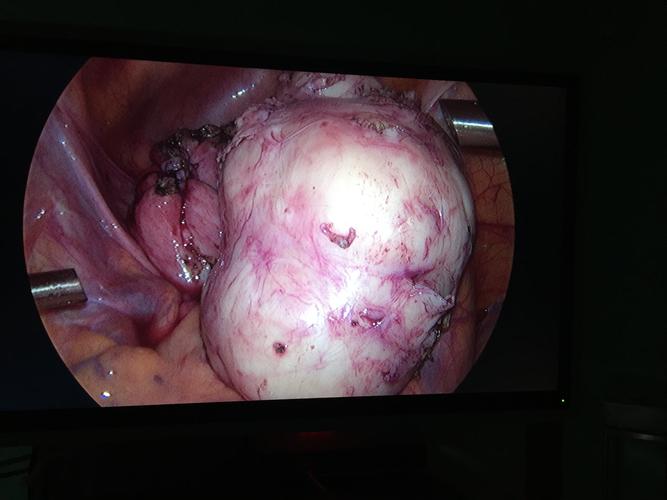 子宫肌瘤腹腔镜手术怎样把肌瘤拿出来