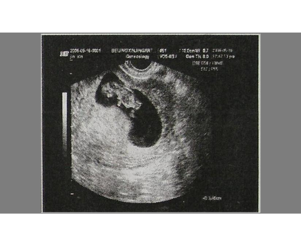 怀孕多久能看到孕囊一个孕囊双胞胎先兆