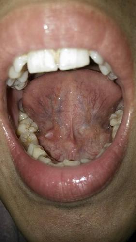 最近舌头下面～舌头下面的中间线缝右边长了一个小舌头!有点不舒服!