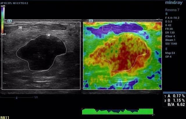 助力乳腺癌诊断的超声弹性成像技术「专利奖巡礼」