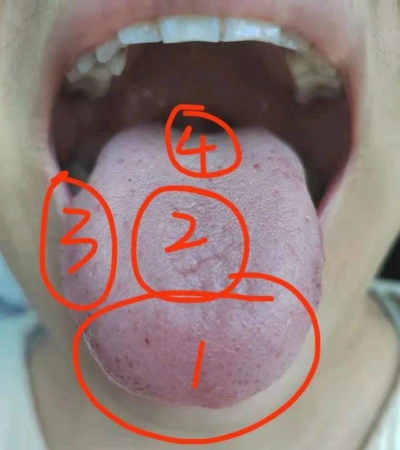 舌像分析:头昏沉  这个舌像舌质比较白微紫,舌苔