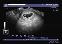 孕囊是怀孕最初的形态,那时候胎儿还没有形成,胎芽出现时已经有胎心