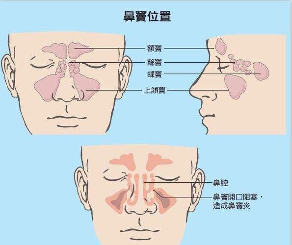 引发鼻窦炎的因素有哪些能治好吗