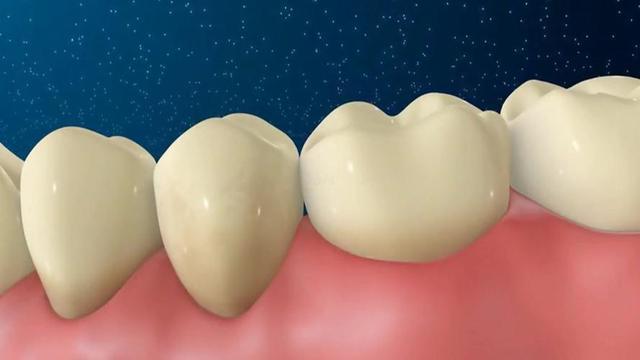冷光美白能让牙齿变得更加亮白,但是不适合有牙齿疾病的患者