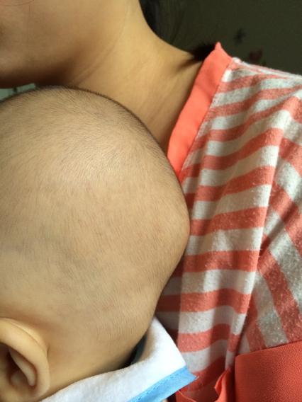 宝宝6个半月,后脑勺长了个包怎么回事?没有碰,没有蚊虫咬