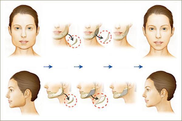 改脸型手术      磨 颧骨手术的危险性大与否其实取决于整形医生的