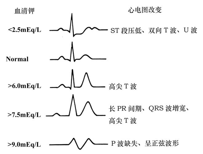 高钾血症的心电图表现 高钾血症(血钾>5.