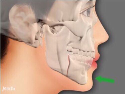 下颌角整形包括磨削术,截骨术,以及综合性手术三种.