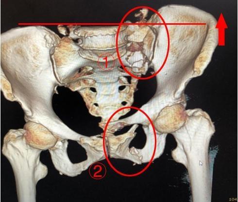 ①后环骶骨骨折,骶髂关节脱位;②前环耻骨上下支骨折 施能兵介绍,创伤