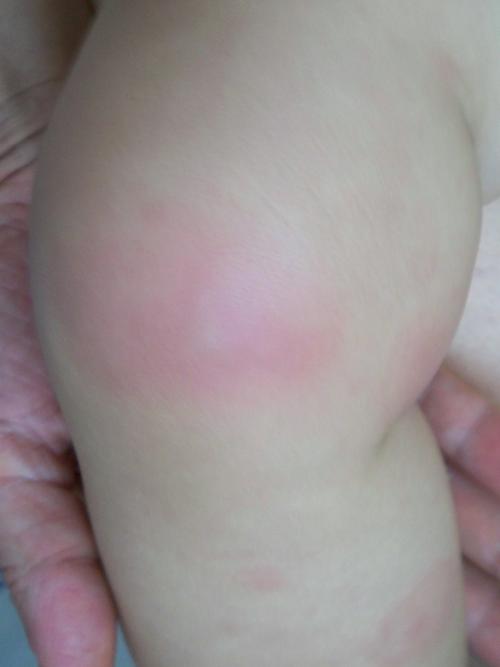 宝宝低烧,四肢有红点后形成红斑