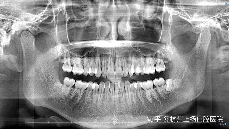 牙齿矫正流程究竟分几步超详细步骤大公开