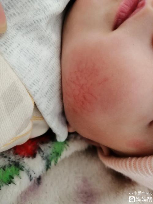 宝宝脸上有好多红血丝皮肤还特别干起皮