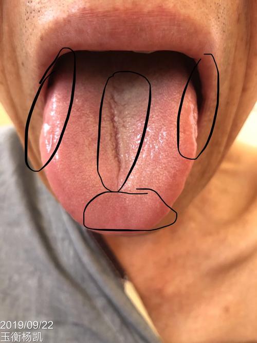胃癌舌头是什么症状