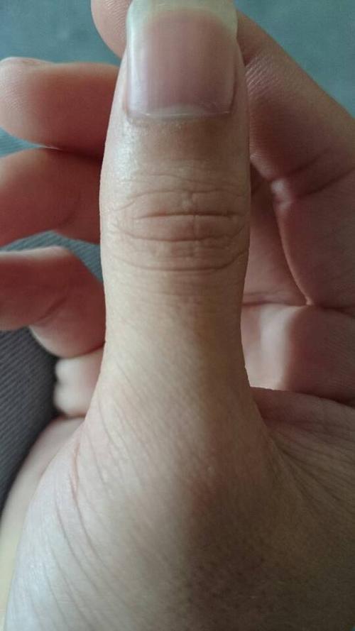 只有右手拇指上有一点点2个毫米左右.其它手指都是正常的指甲颜色.