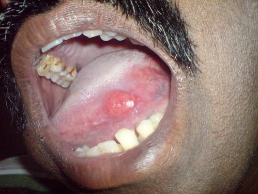 口腔肿瘤一般长在哪里