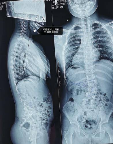 郑骨医,小儿骨科二脊柱侧弯科短阶段固定治疗脊柱侧弯一例