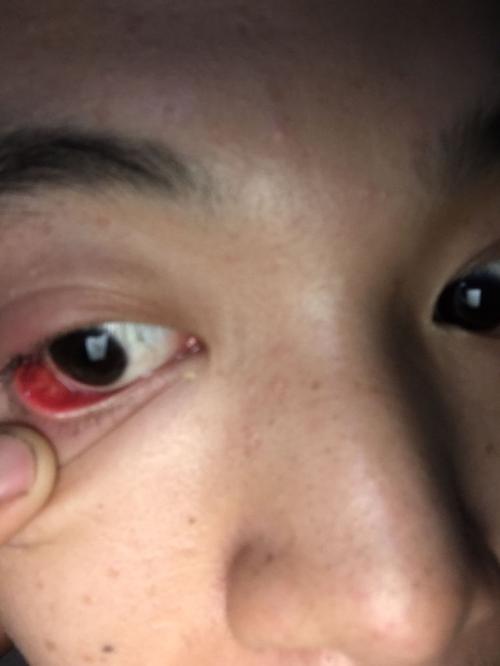 下眼睑红肿里面还有个红色的小包是什么症状.眨眼还疼