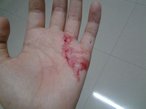 我的手掌被菜刀切了应该怎样处理?