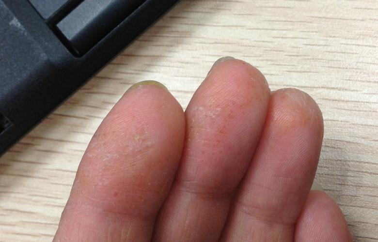 手指指尖处出现这样的水泡是什么病,不痛不痒,过几天长水泡的皮肤会变