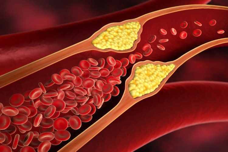 胆固醇中有一种称为低密度脂蛋白的坏胆固醇,会在动脉血管中形成斑块