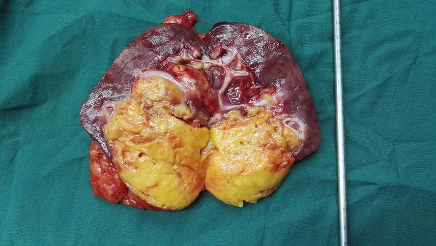 巨大的肾错构瘤哪些可以微创手术保留肾脏