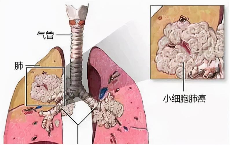 恶性肿瘤,特别是肺癌的自发缓解是罕见的,在非小细胞肺癌(nsclc)中