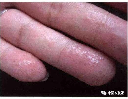 手指疱疹怎么治疗
