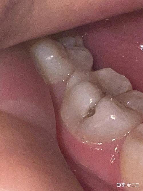 牙齿有个洞该补吗