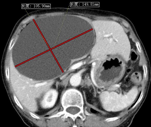 病例一,患者女,55岁,腹部不适,ct发现肝巨大囊肿.