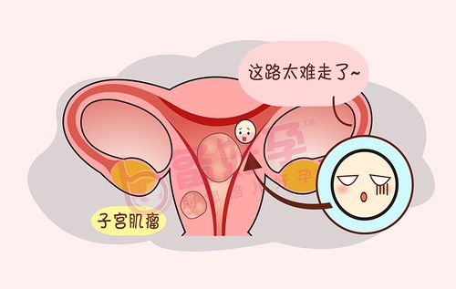 备孕期间查出子宫肌瘤怀孕还有希望吗