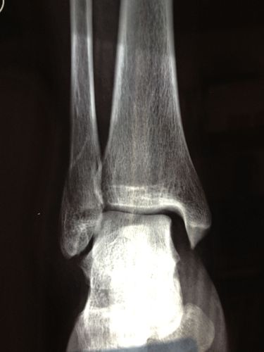 右脚踝扭伤,腓骨骨折,关节移位.请看x光片,谢谢.
