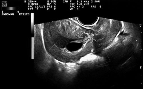 彩色多普勒超声和超声造影联合在子宫切口妊娠早期诊断中的价值