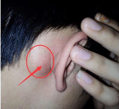 耳朵后面长硬包是怎么回事?真的是肿瘤吗?