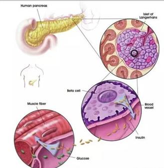 导管直接移植成体干细胞到人类的胰岛中,使干细胞在胰腺微环境的诱导