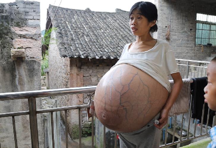 2年时间女子肚子疯长成巨球,抽腹水,吃中药.