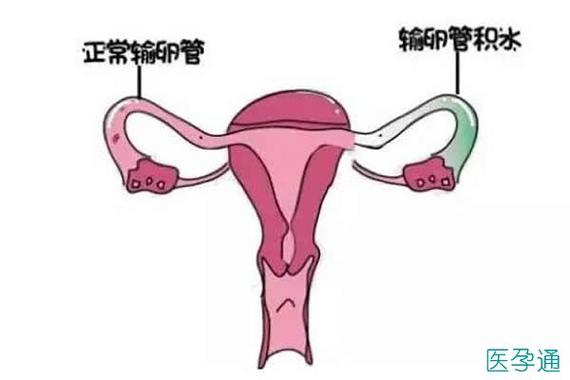 输卵管积水是由同房不洁或过度人流等引起感染而造成的,不仅会对子宫