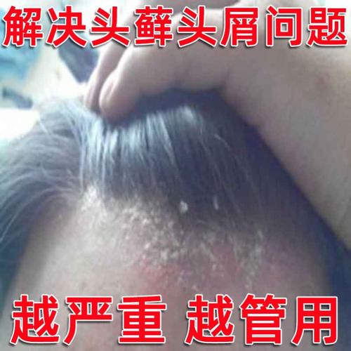 一折去头皮癣洗发水_头皮真菌感染治疗洗发水头皮癣专用药膏头部去