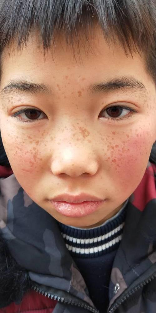 阿克苏地区新和县儿童脸上长斑的原因阿克苏地区新和县龟头有红斑