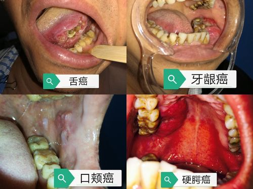 口腔癌的治疗和预防(附图片)
