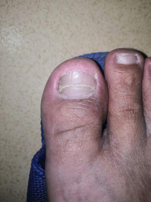 这几天才发现右大脚趾指甲有一道横纹,是不是缺什么元素!懂的人说说!