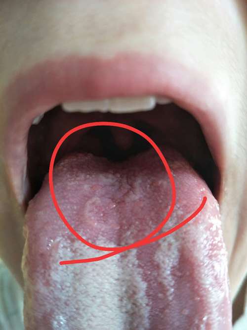 舌头根部有很多痘痘 喉咙干疼